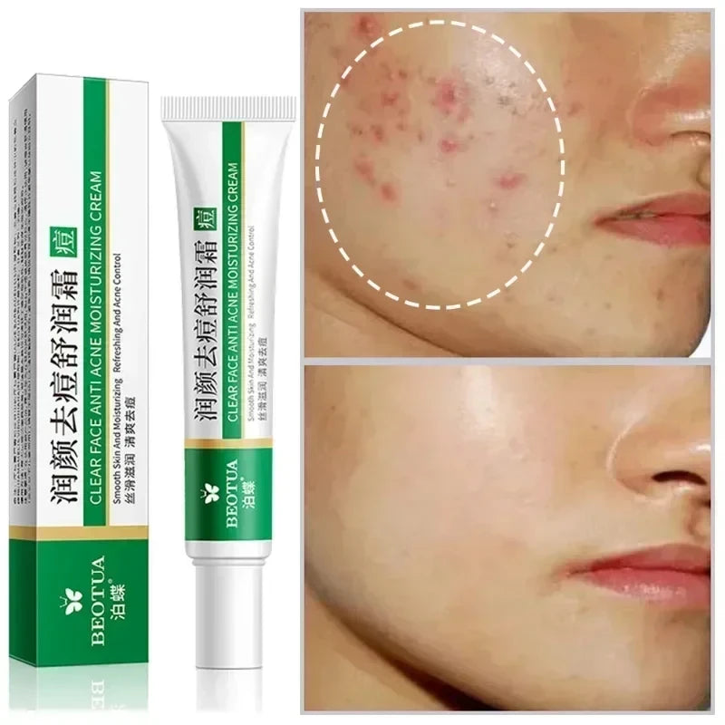 Herbal Acne Treatment Cream Face Scar Blackhead Remover Repair Gel Oil Control Shrink Pores Whitening Skin Care Korean Cosmetics