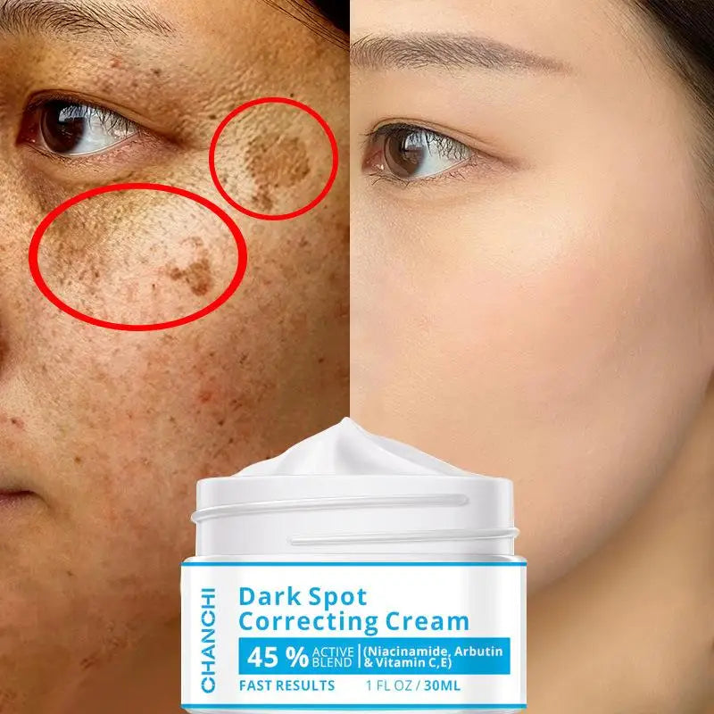 Whitening Freckles Cream Remove Melasma Dark Spot Lightening Melanin Brightening Melasma Remover Moisturize Anti-aging Face Care