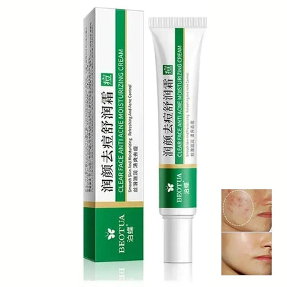 Herbal Acne Treatment Cream Face Scar Blackhead Remover Repair Gel Oil Control Shrink Pores Whitening Skin Care Korean Cosmetics